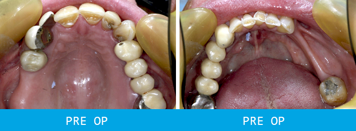 Second Before and after dental implants case study at our Watford dentist, Senova Dental Studios in Watford, Hertfordshire