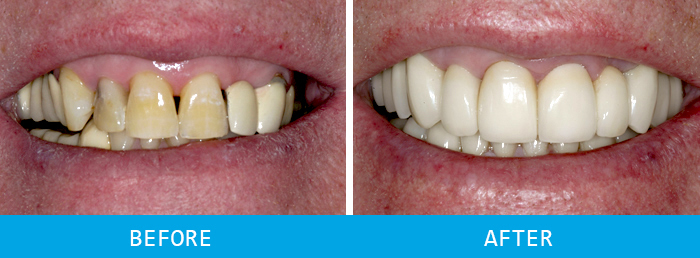 Third Before and after dental implants case study at our Watford dentist, Senova Dental Studios in Watford, Hertfordshire