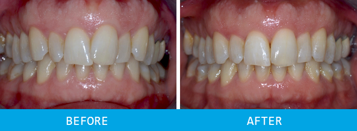 Invisalign near me before and after