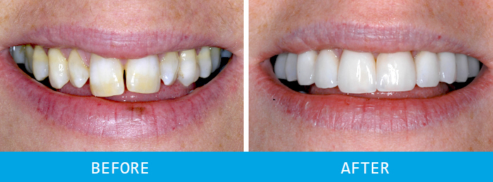 Veneers Case Study