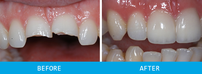 Before and after crowns case study at our Watford dentist, Senova Dental Studios in Watford, Hertfordshire