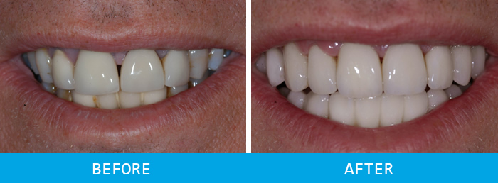 Second before and after crowns case study at our Watford dentist, Senova Dental Studios in Watford, Hertfordshire