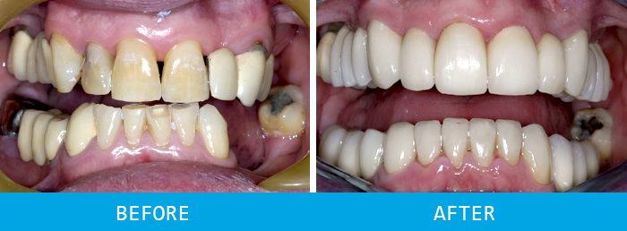 First Before and after dental implants case study at our Watford dentist, Senova Dental Studios in Watford, Hertfordshire