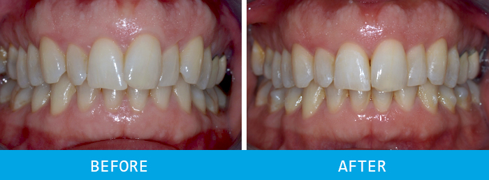 Before and after braces