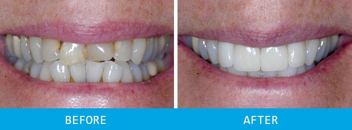 Smile Makeover Case Study