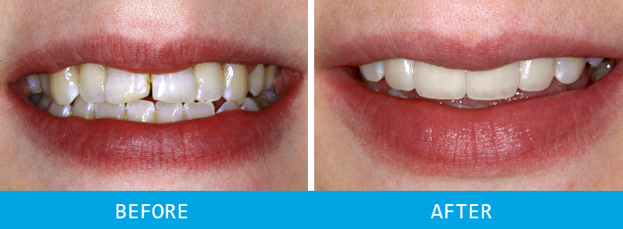 Smile Makeover Case Study