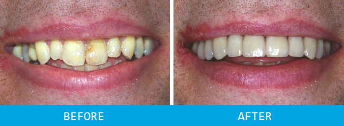 Smile Makeover Case Study