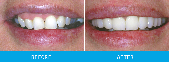 Smile Makeover Case Study