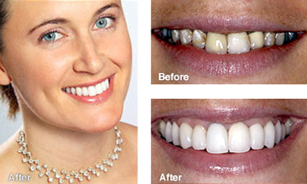 Smile Makeover Case Study