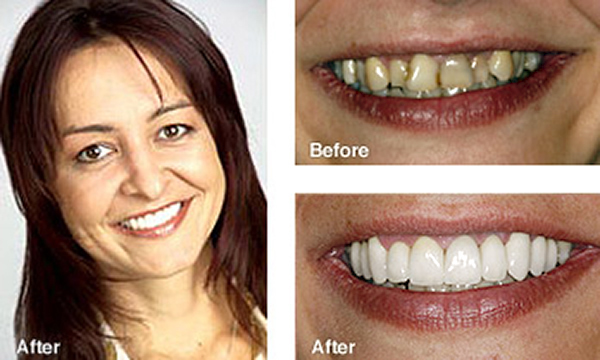 Smile Makeover Case Study