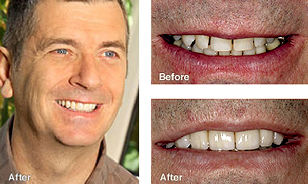 Smile Makeover Case Study