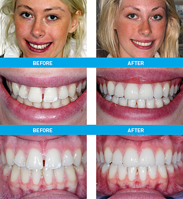 Veneers Case Study