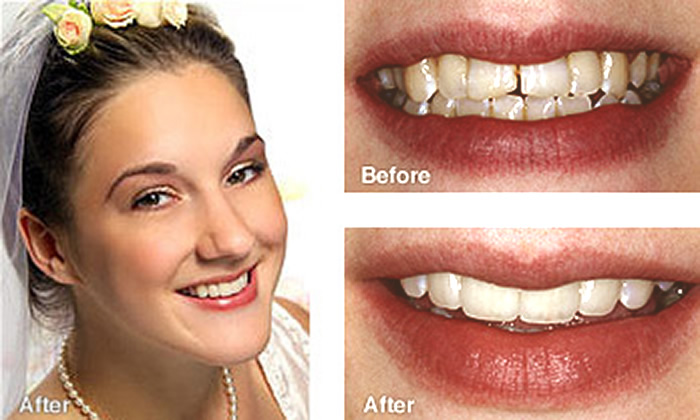 Veneers Case Study