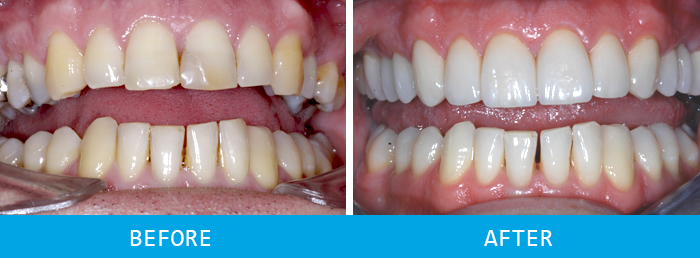 Veneers Case Study