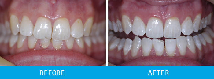 Teeth Whitening Case Study