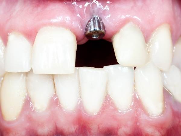 dental implants watford