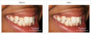 Six Month Smiles Case review three