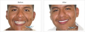 Six Month Smiles Case review two