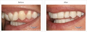 six month smile case review one