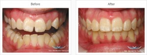 Six Month Smiles Case review three