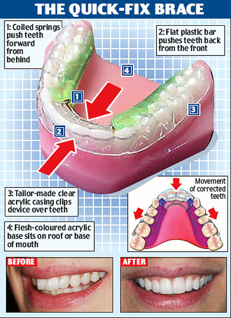 bracegpx2101_468x643