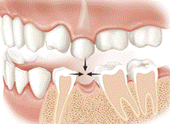 bone-loss