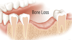 resorption