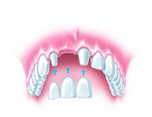 A dental bridge