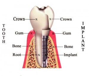 Dental implant diagram