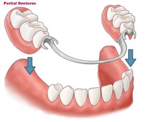 Dentures