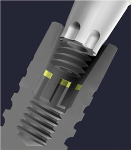 Dental implant component cost