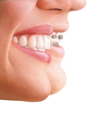 Invisalign versus conventional braces