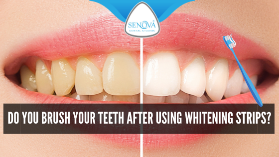 Do You Brush Your Teeth after Using Whitening Strips?