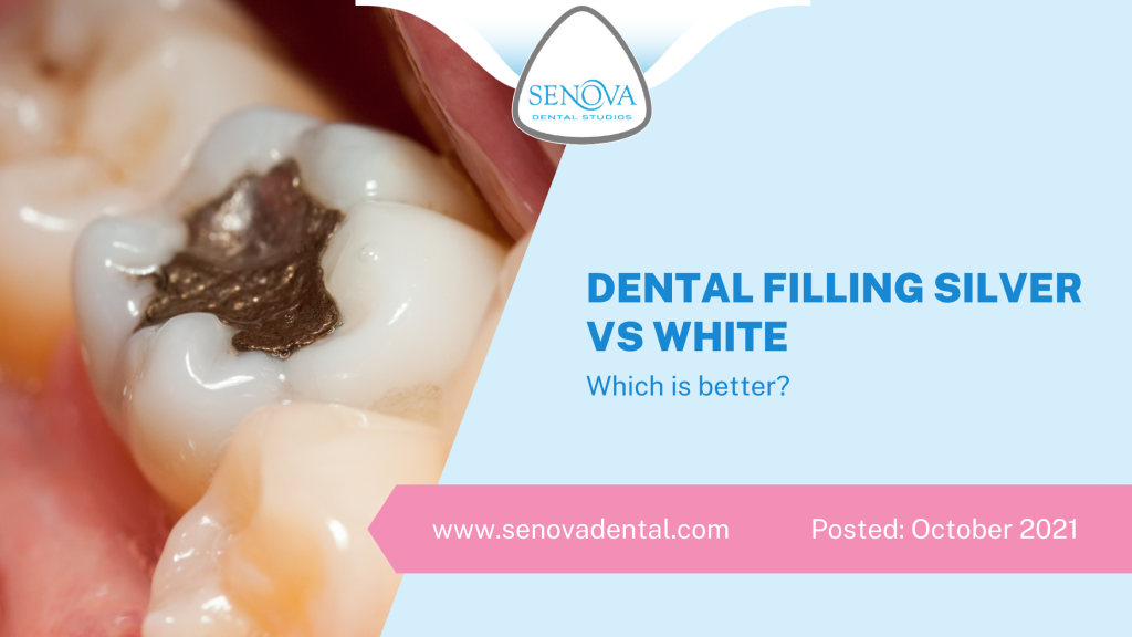 Dental Filling Silver Vs White - Which Is Better?