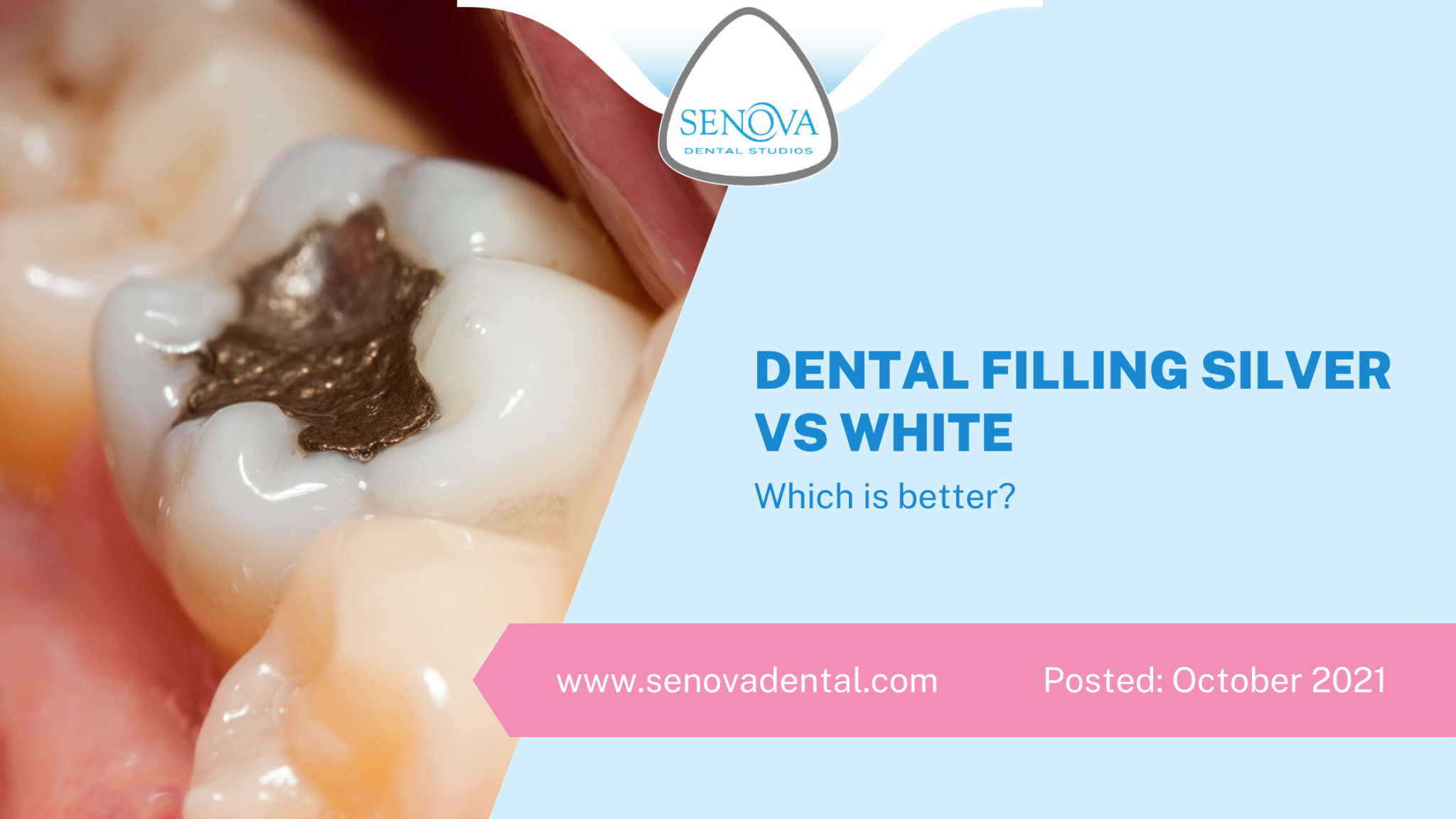 Dental Filling Silver Vs White Which Is Better? Senova Blog