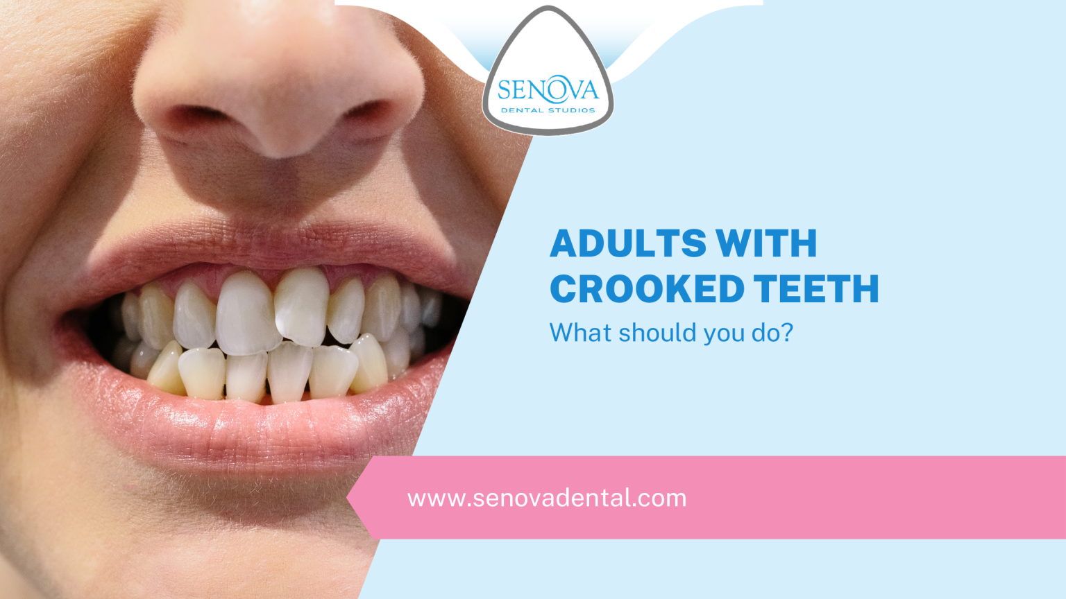 Adults With Crooked Teeth What Should You Do? Senova Blog