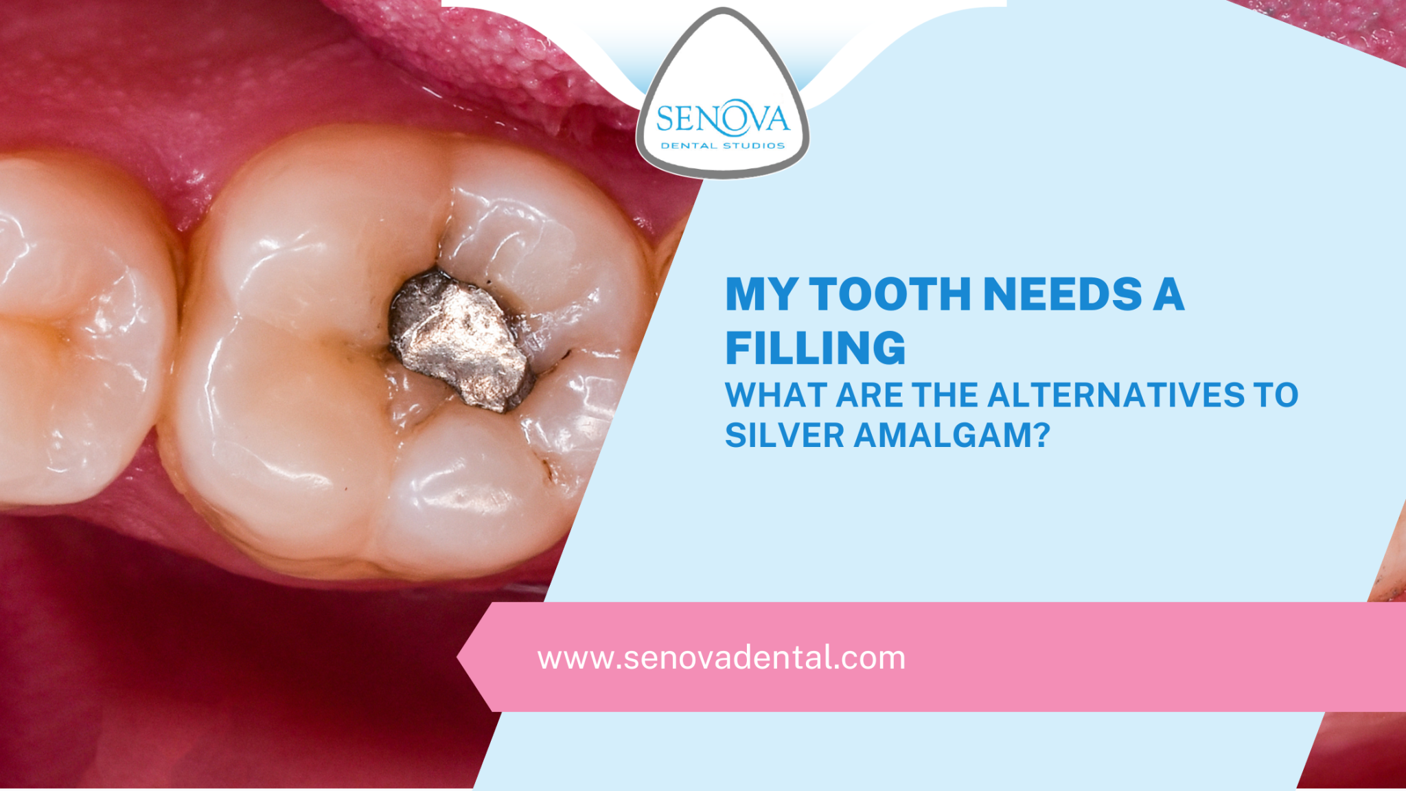 My Tooth Needs A Filling What Are The Alternatives To Silver Amalgam