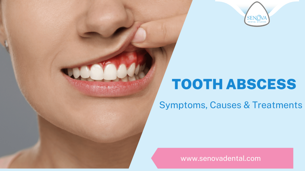 Tooth Abscess: Symptoms, Causes & Treatments – Senova Blog