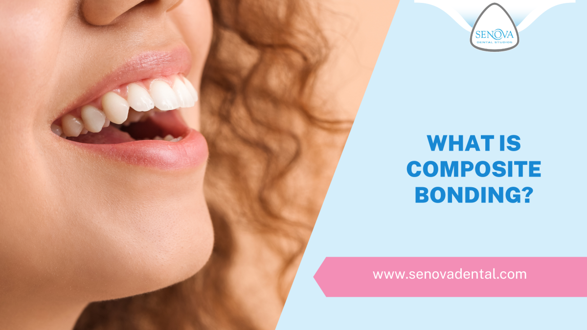 What Is Composite Bonding?